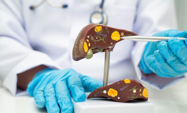 Gordura no fígado pode ser ocasionada pela síndrome metabólica: saiba mais