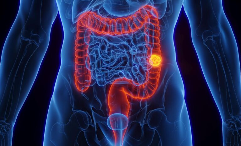 Existe relação entre obesidade e câncer de intestino?